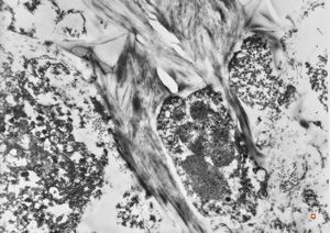 M,27y. | intracellular cholestasis - intoxication M,27y. | intracellular cholestasis - intoxication